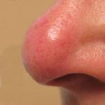 Купероз на лице: причины появления и методы лечения Купероз на щеках что делать