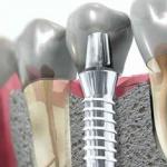 Что такое зубной штифт и как его устанавливают Штырь в зубе